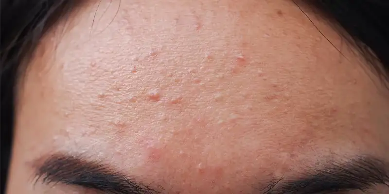cara mengatasi fungal acne