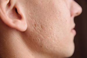 masalah kulit wajah pria, kulit berminyak pria, jerawat pria, iritasi bercukur, perawatan kulit pria, skincare pria, kulit kusam pria, komedo pria, pori besar, kulit sensitif pria, tips grooming pria, cara merawat wajah pria, flek hitam pria, bekas jerawat pria, kulit kering pria, moisturizer pria, sunscreen pria, facial wash pria, eva mulia clinic, perawatan kulit harian pria