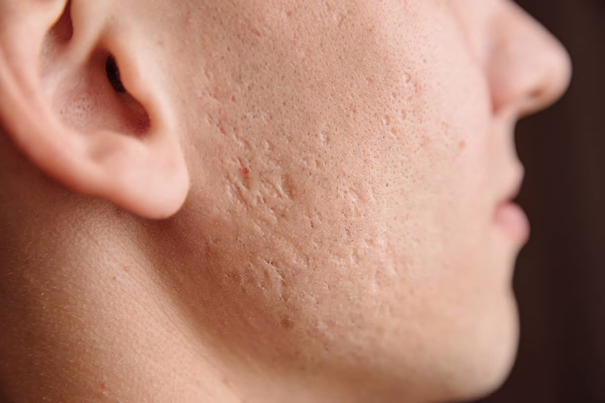 masalah kulit wajah pria, kulit berminyak pria, jerawat pria, iritasi bercukur, perawatan kulit pria, skincare pria, kulit kusam pria, komedo pria, pori besar, kulit sensitif pria, tips grooming pria, cara merawat wajah pria, flek hitam pria, bekas jerawat pria, kulit kering pria, moisturizer pria, sunscreen pria, facial wash pria, eva mulia clinic, perawatan kulit harian pria