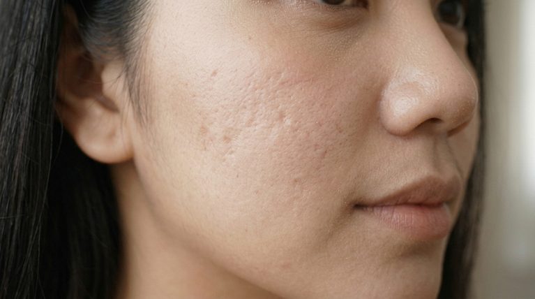 Kenapa Krim Skincare Tidak Bisa Menghilangkan Bopeng Jerawat?